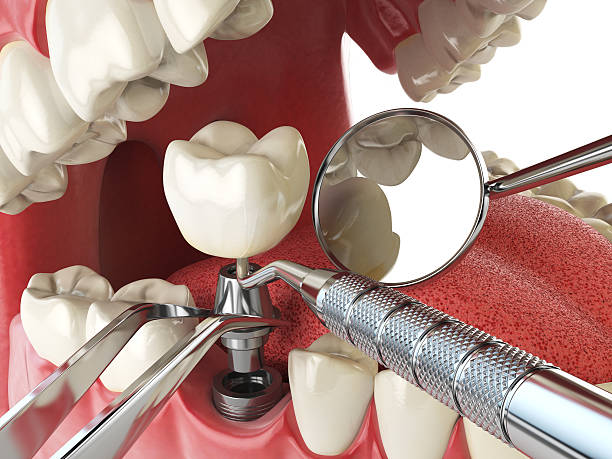 Best Urgent Tooth Repair  in Palm Shores, FL
